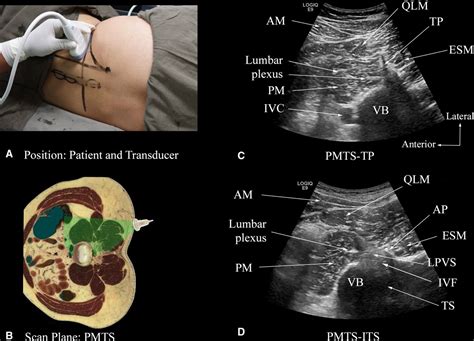 Ultrasound Visualization Of The Anatomy Relevant For Lumbar Plexus
