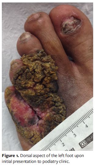 Rare Presentation Of Squamous Cell Carcinoma Of The Foot