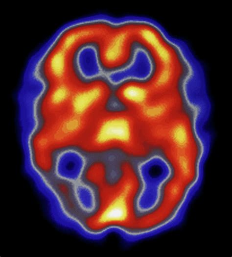 Colour Spect Scan Of Brain During Migraine Attack Photograph By Dept