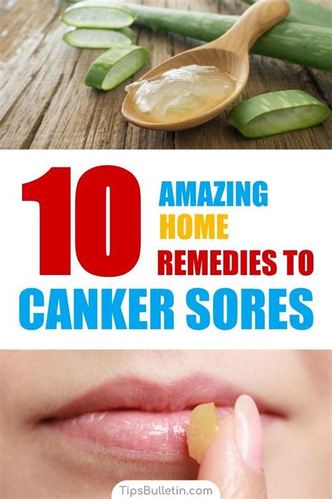 10 amazing homemade solutions for canker sores in 2020 canker sore canker sore remedy cankers