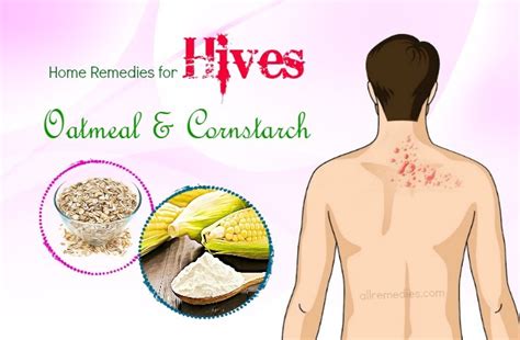 Top 16 Natural Home Remedies For Hives On Face And Body