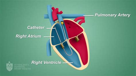 Right Heart Catheter St Vincents Heart Health