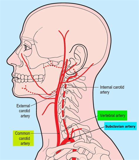Vertebral Artery Segments Stenosis And Artery Dissection Symptoms