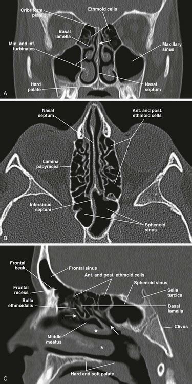 Ethmoid Sinus Anatomy In A Year Old Girl Sagittal Ct Image In Bone