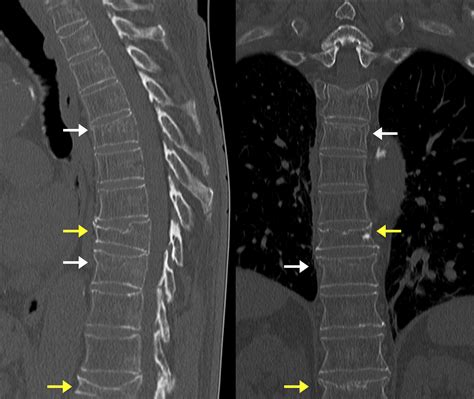 Acute And Chronic Vertebral Compression Fractures Image