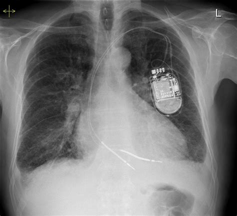 Pulmonary oedema - Kerley B lines - Radiology at St. Vincent's