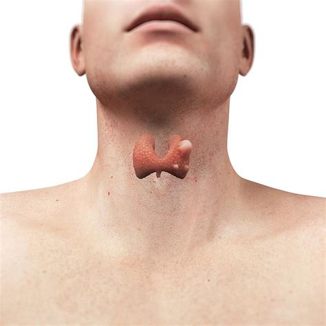Thyroid Gland Cancer 4 Photograph By Scieproscience Photo Library