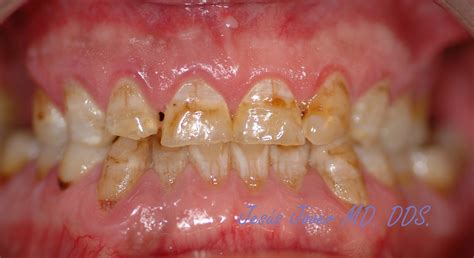 Grupo De Estudios Odontológicos De Cuenca Fluorosis Dental En Paciente