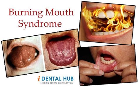 Burning Mouth Syndrome May Occur As An Isolated Symptom Or As One Of A Group Of Oral Symptoms