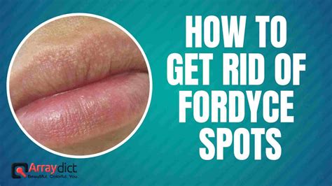 3 Best Ways To Get Rid Of Fordyce Spots On Lips