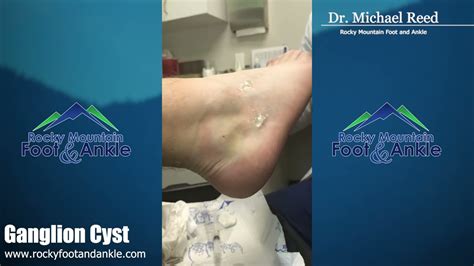 Ganglion Cyst Treatment In Meridian And Caldwell Experienced Idaho Podiatrist Rocky Mountain