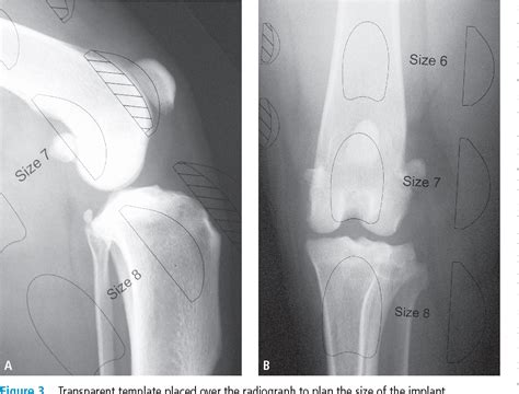 Figure 1 From Patellar Groove Replacement In Patellar Luxation With