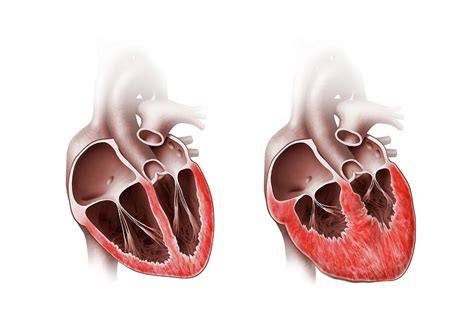 Normal And Enlarged Hearts Photograph By Henning Dalhoff Science