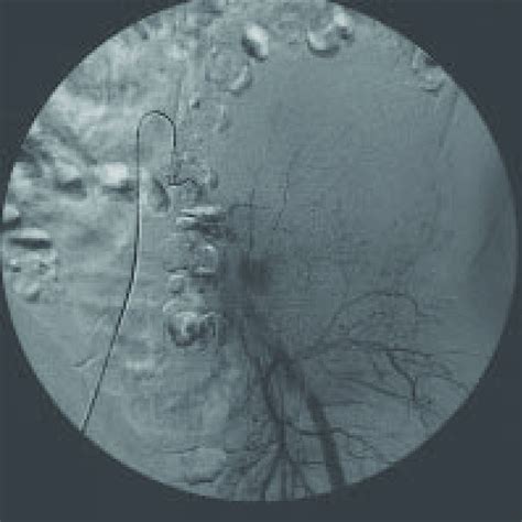 Late Phase Of Selective Left Common Iliac Angiogram Showed Faint Stains
