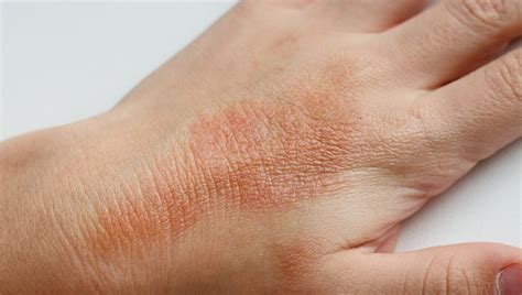Dermatita Atopic Simptome I Cauze