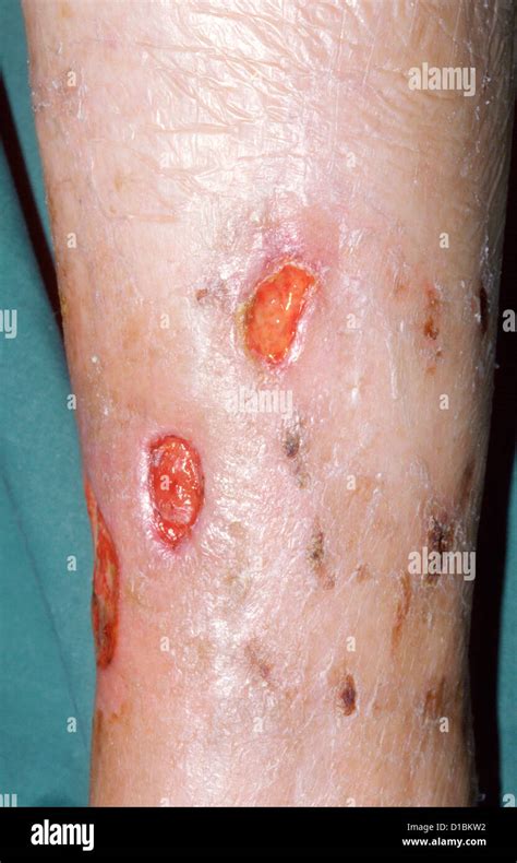 Vasculitic Ulcers Stock Photo Royalty Free Image 52502830 Alamy