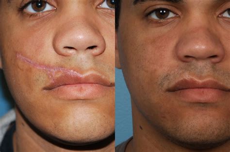 Scar Revision Northwestern Facial Plastic Surgery