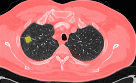 Benign Lung Nodules Identified Using Proteomic Biomarker Pulmonology