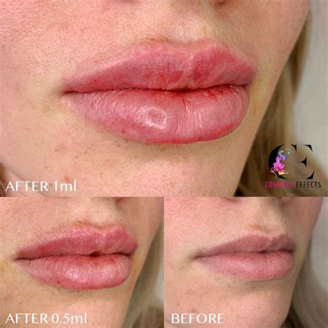 Ml Or Ml Of Lip Fillers What S Right For You Lip Fillers Lips