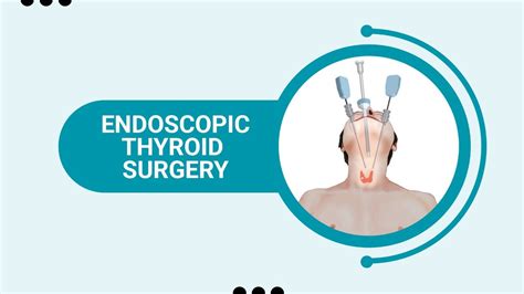 Endoscopic Thyroid Surgery