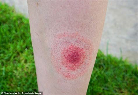 Englands Lyme Disease Hotspots Revealed As Experts Share The Five