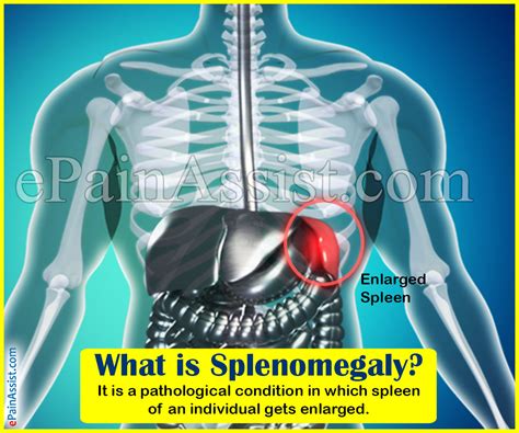 What Is Splenomegalycausessymptomstreatmentdiagnosis