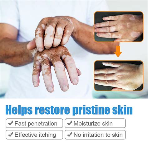 20g Herbal Extract Vitiligo Ointment Remove Ringworm White Spot Removal