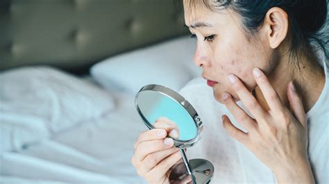 New Study Finds Adult Acne Has Psychological Toll On Women Woman And Home