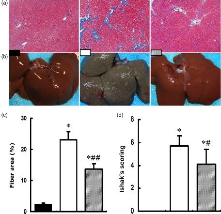 Liver Fibrosis And Cirrhosis In Three Groups A Histology Of Liver