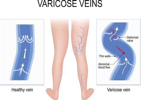 Differences Between Varicose And Spider Veins Sunshine Coast Vascular