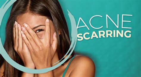Acne Scarring Remedies At W Cosmetic Surgery W Cosmetic Surgery™