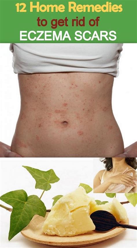 Natural Remedies For Eczema Scars