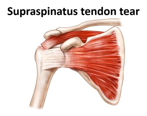Partial Thickness Tear Supraspinatus Tendon