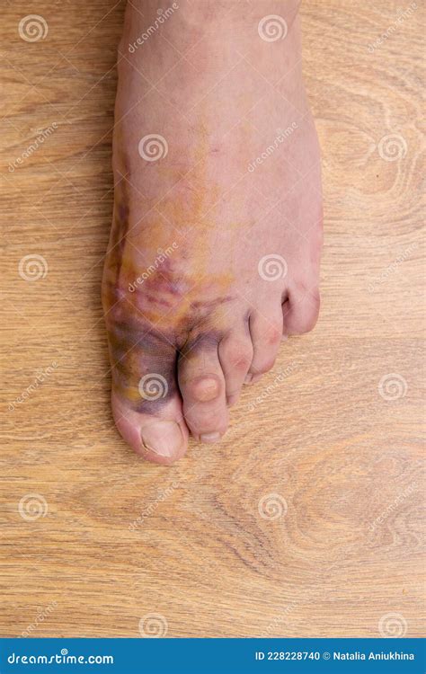 Swollen Injured Male Limb On The Left Foot With Hematoma When A Heavy