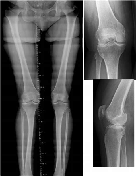 Varus Valgus Knee Deformity