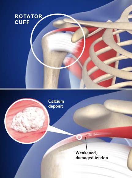 Calcific Tendinitis Of The Shoulder Central Coast Orthopedic Medical Group