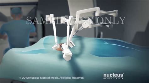 Robotic Thyroidectomy By PharmAlliance YouTube