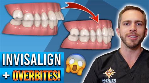 Invisalign Overbite Treatment BEFORE AFTER YouTube
