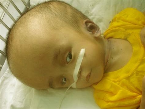 Hydrocephalus Causes Symptoms Causes Treatment And Prevention Of Diseases