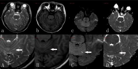 Acute Ischemia Stroke A Rare And Severe Complication Of Ovarian