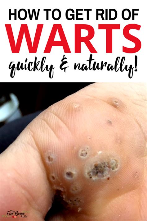 Remove A Wart Naturally Using Garlic Warts Get Rid Of Warts How My
