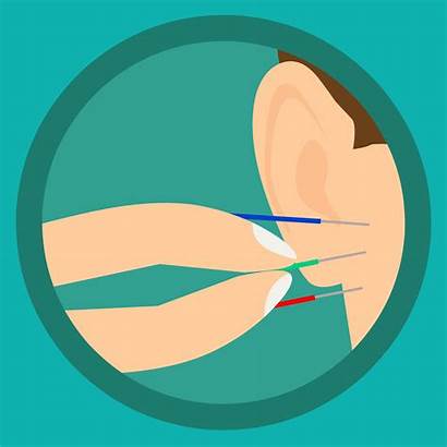 Acupuncture Treatment Ear Chinese Health Needles Therapy