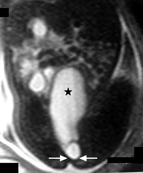 Congenital Imperforate Hymen With Hydrocolpos Diagnosed Using Prenatal