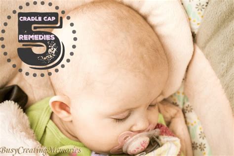 Natural Cradle Cap Remedies That Actually Work How To Safely And