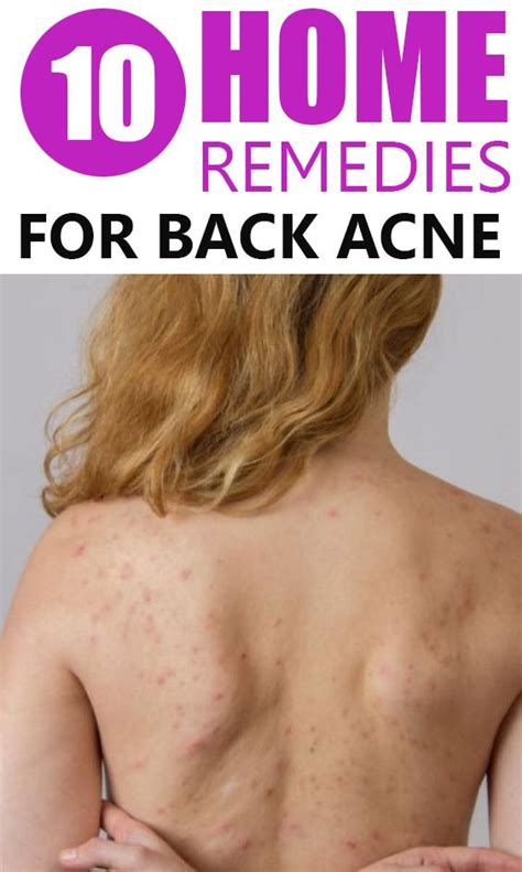 Best Home Remedies For Back Acne Back Acne Remedies Home Remedies