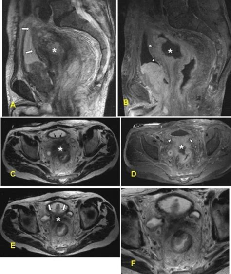 Mri Of The False Positive Case In The Group With A Nonc Open I
