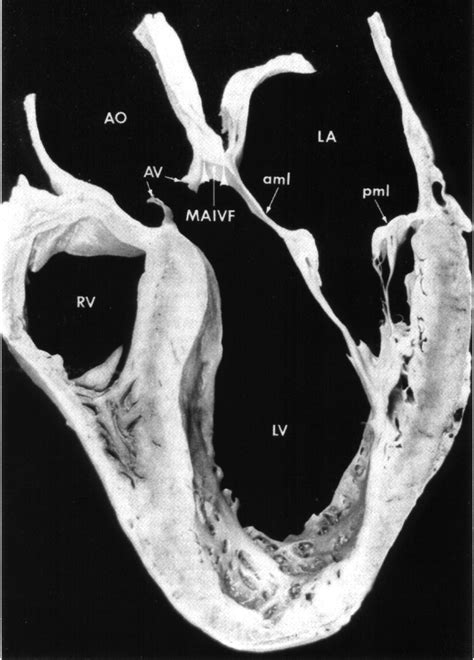 Pseudoaneurysm Of Mitral Aortic Intervalvular Fibrosa
