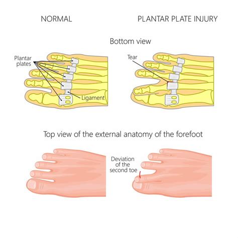 Plantar Plate Tear Farnsworth Orthopedic Physical Therapy