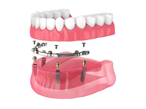 Removable Partial Dentures Stock Photos Pictures And Royalty Free Images