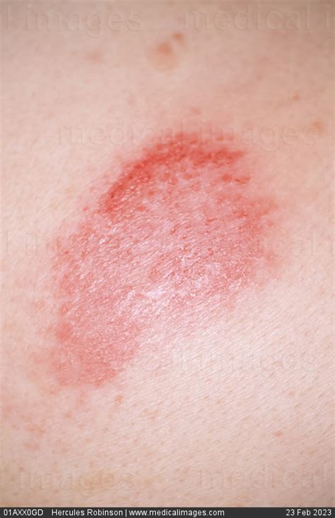 Stock Image Dermatology Psoriasis A Scaly Red Patch On The Torso Of A